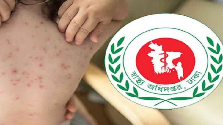 হামের উপসর্গে আরও ৫ শিশুর মৃত্যু
